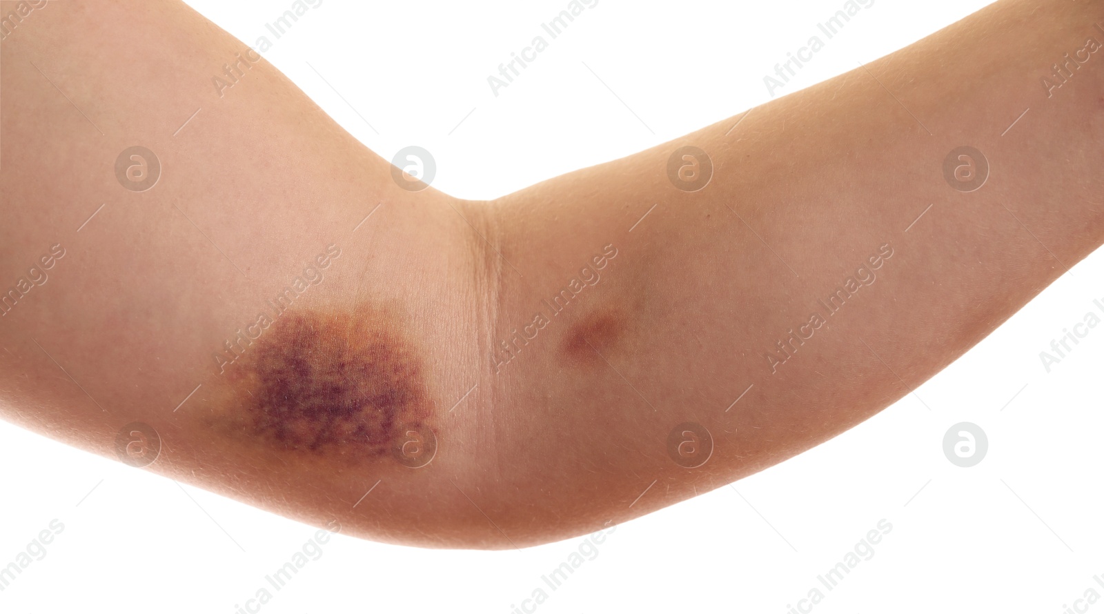 Photo of Woman with bruise on arm against white background, closeup