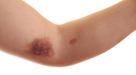 Photo of Woman with bruise on arm against white background, closeup