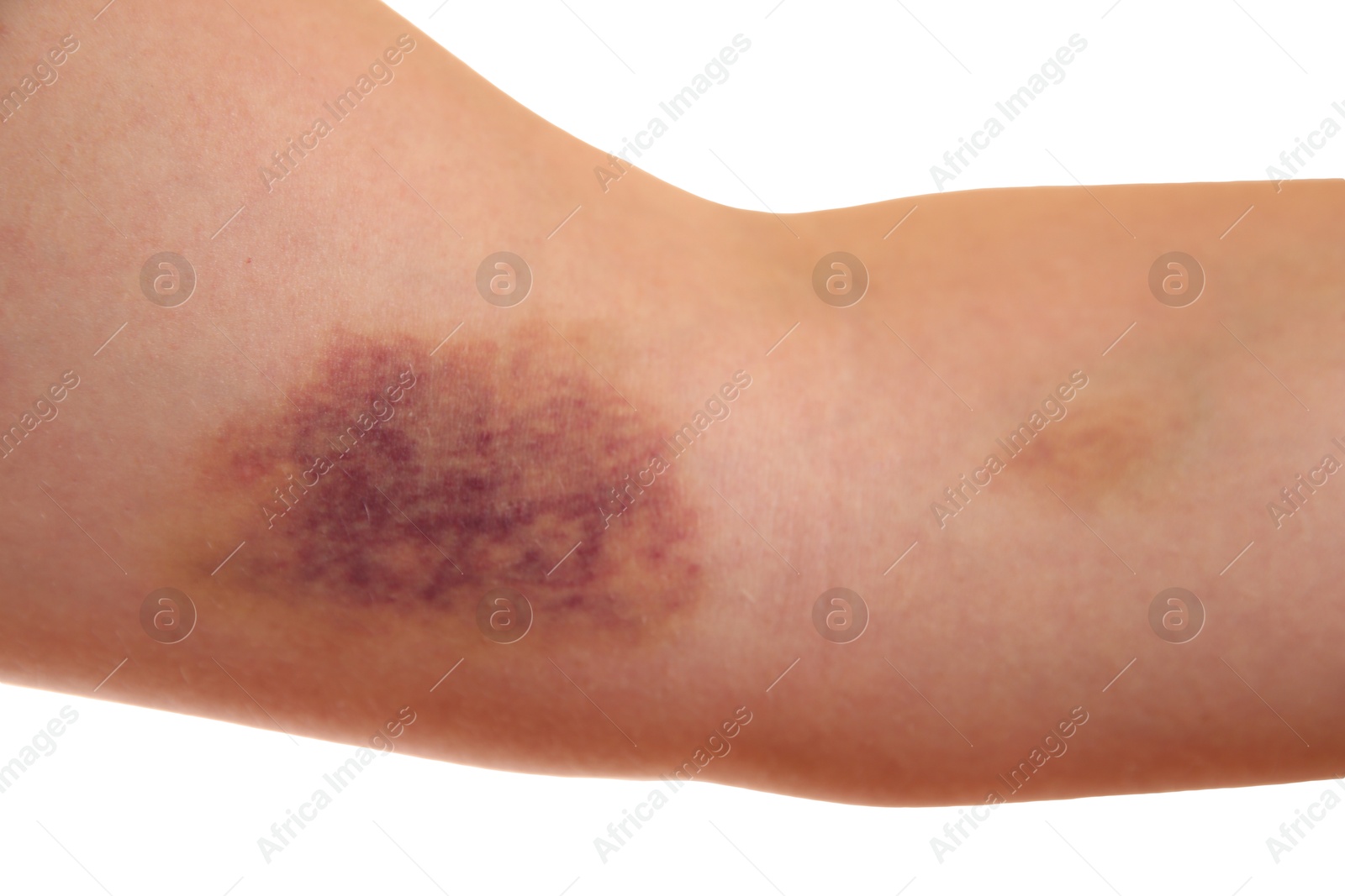 Photo of Woman with bruise on arm against white background, closeup