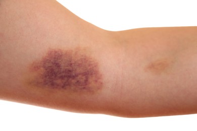 Photo of Woman with bruise on arm against white background, closeup