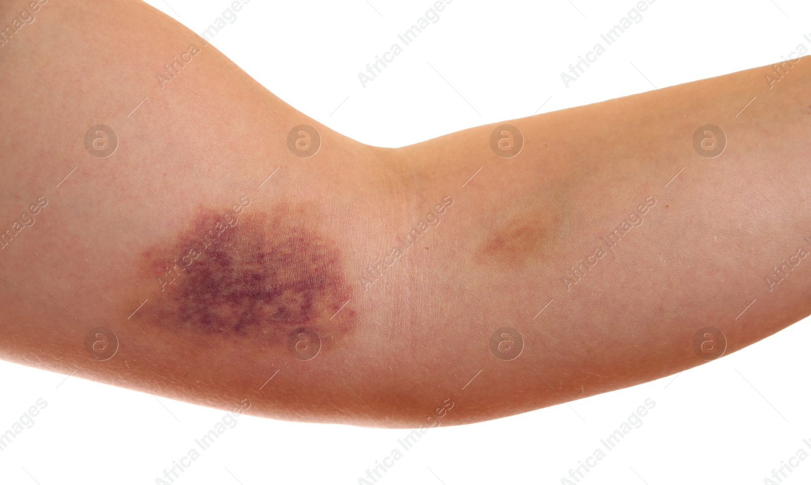 Photo of Woman with bruise on arm against white background, closeup