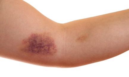 Photo of Woman with bruise on arm against white background, closeup