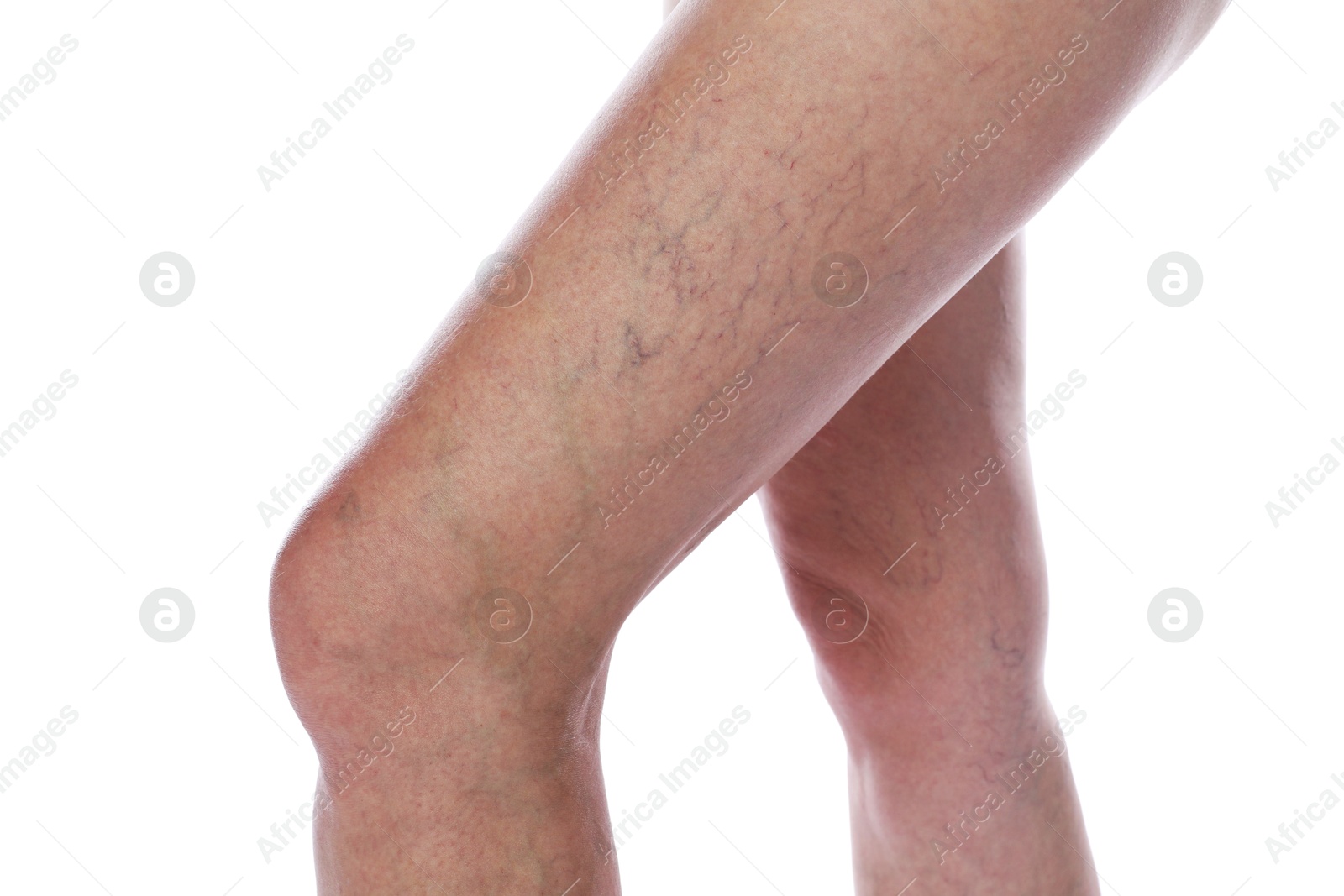 Photo of Woman with varicose veins on white background, closeup