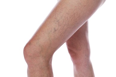 Photo of Woman with varicose veins on white background, closeup