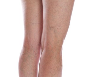 Photo of Woman with varicose veins on white background, closeup