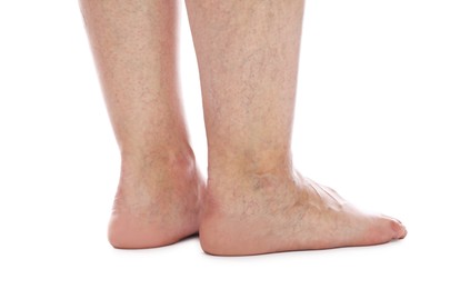 Photo of Woman with varicose veins on white background, closeup