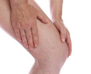 Photo of Woman suffering from varicose veins on white background, closeup