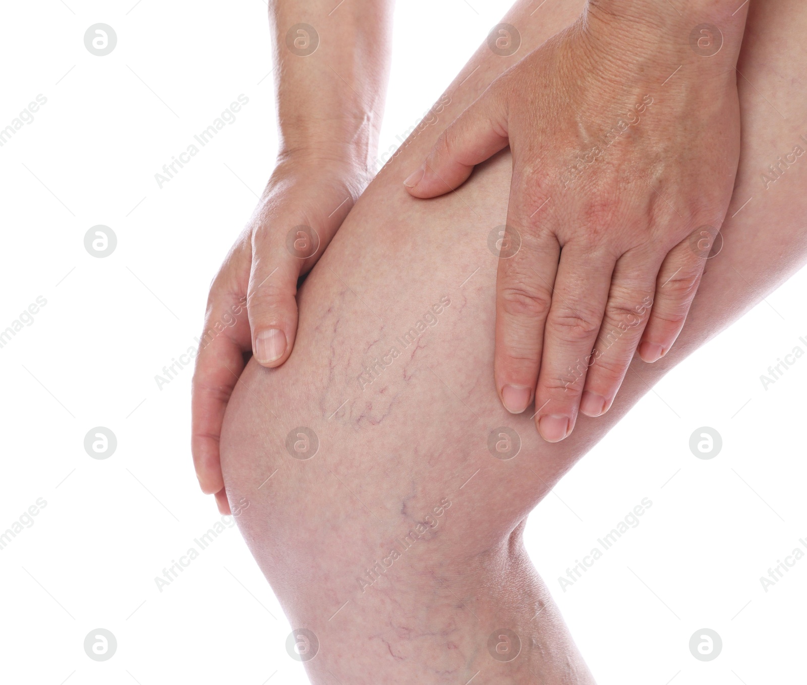 Photo of Woman suffering from varicose veins on white background, closeup