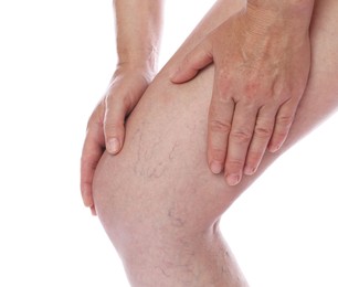 Photo of Woman suffering from varicose veins on white background, closeup