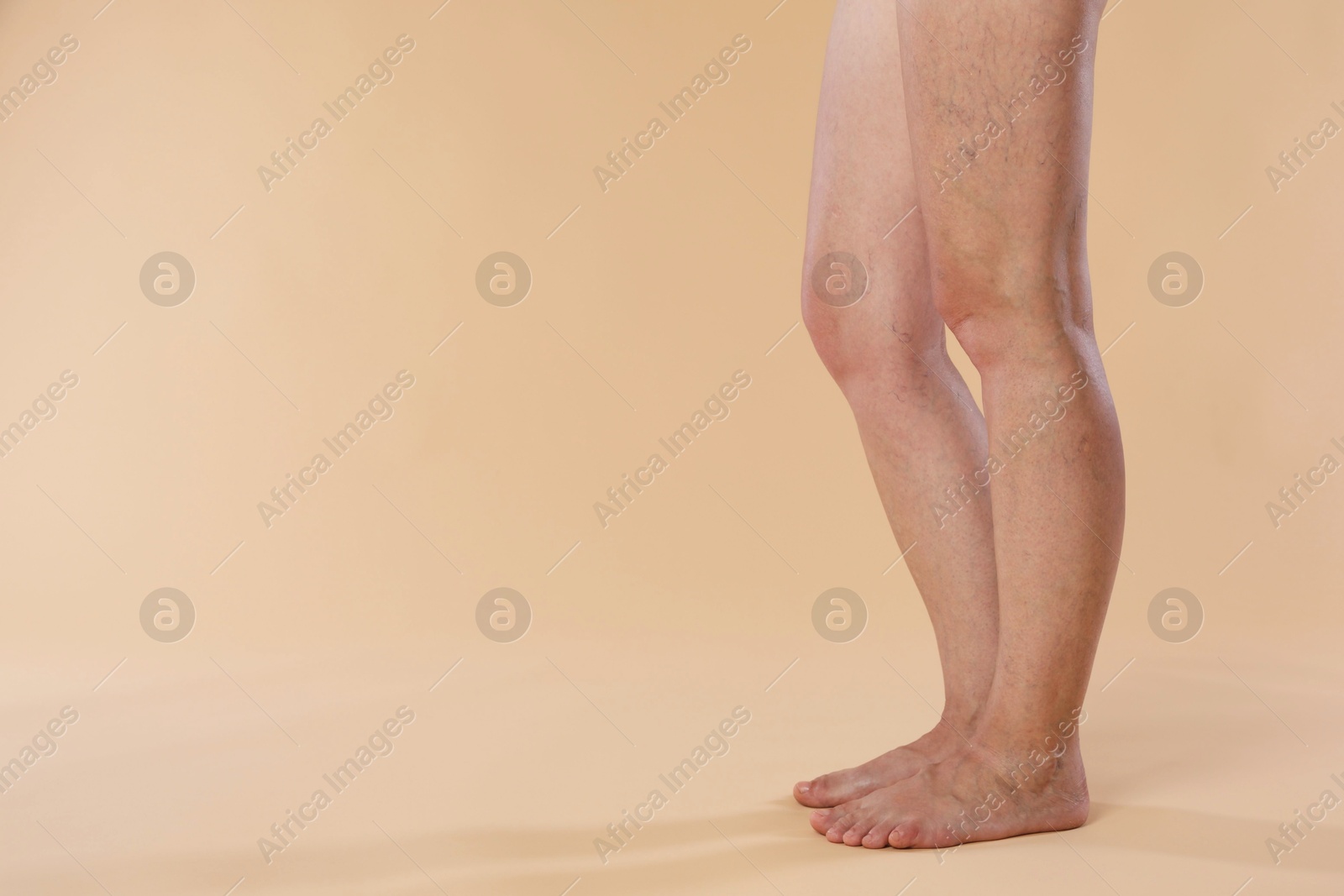 Photo of Woman with varicose veins on beige background, closeup. Space for text