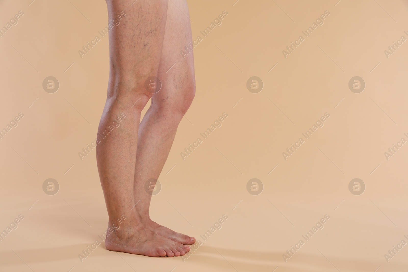 Photo of Woman with varicose veins on beige background, closeup. Space for text