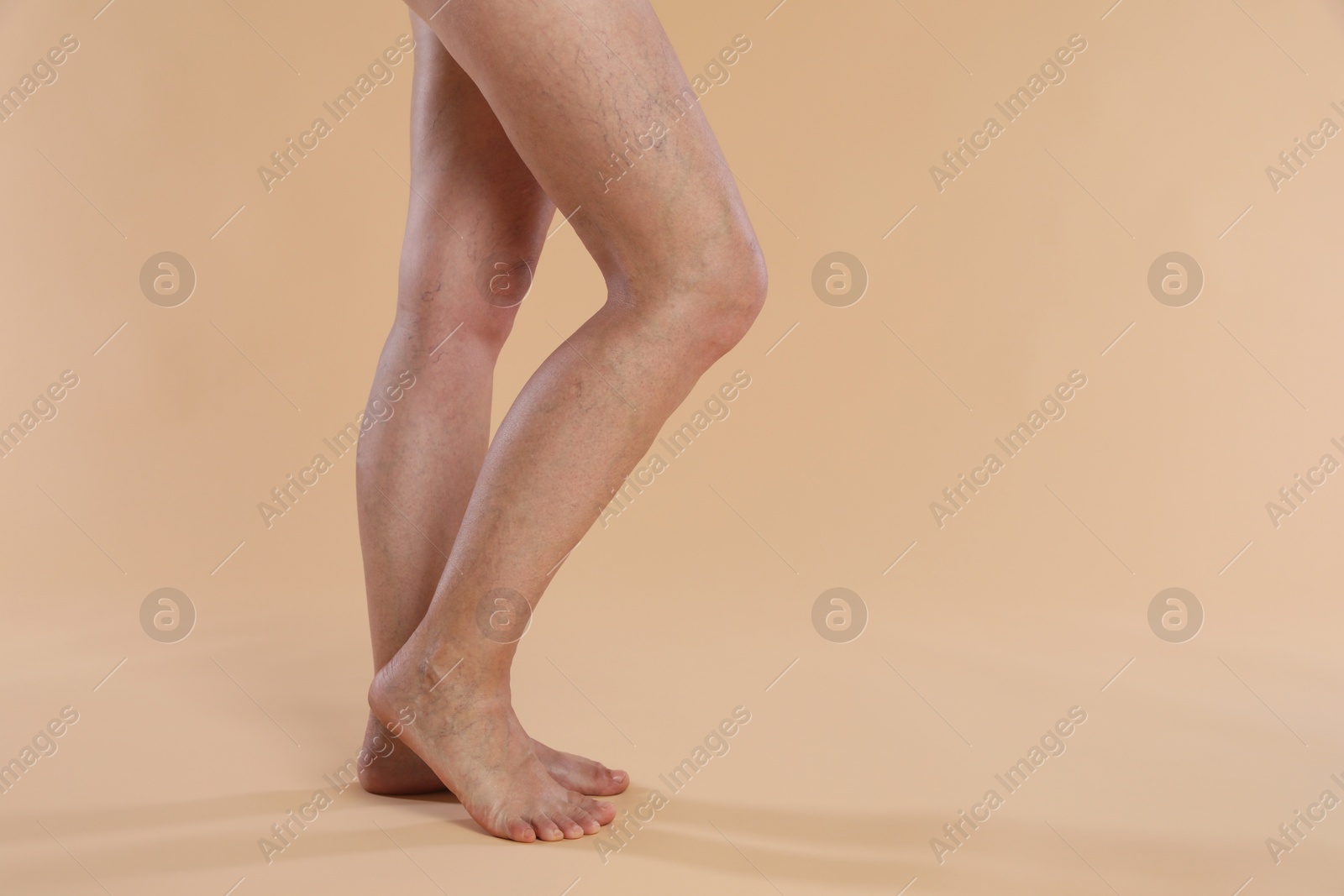 Photo of Woman with varicose veins on beige background, closeup. Space for text