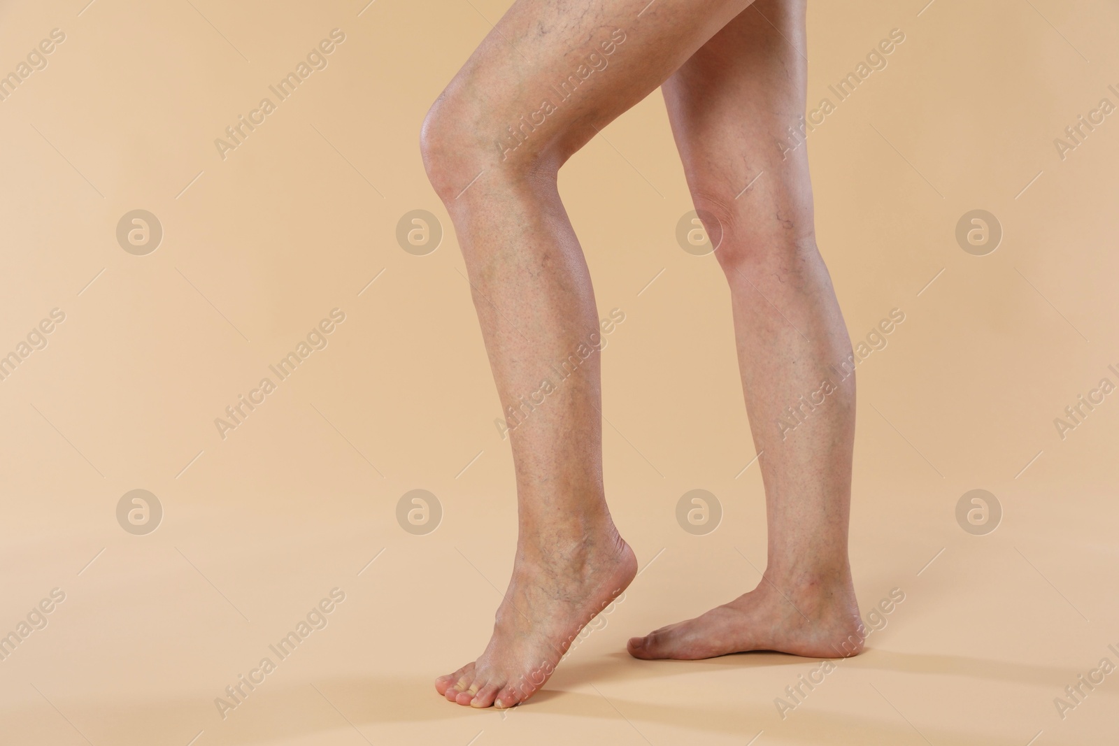 Photo of Woman with varicose veins on beige background, closeup