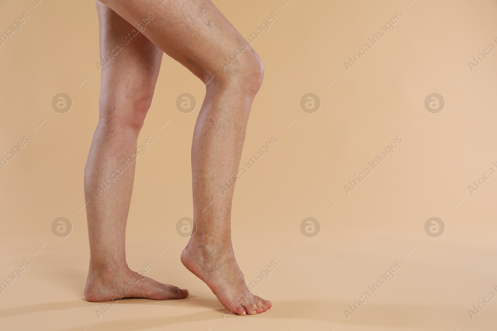 Photo of Woman with varicose veins on beige background, closeup. Space for text