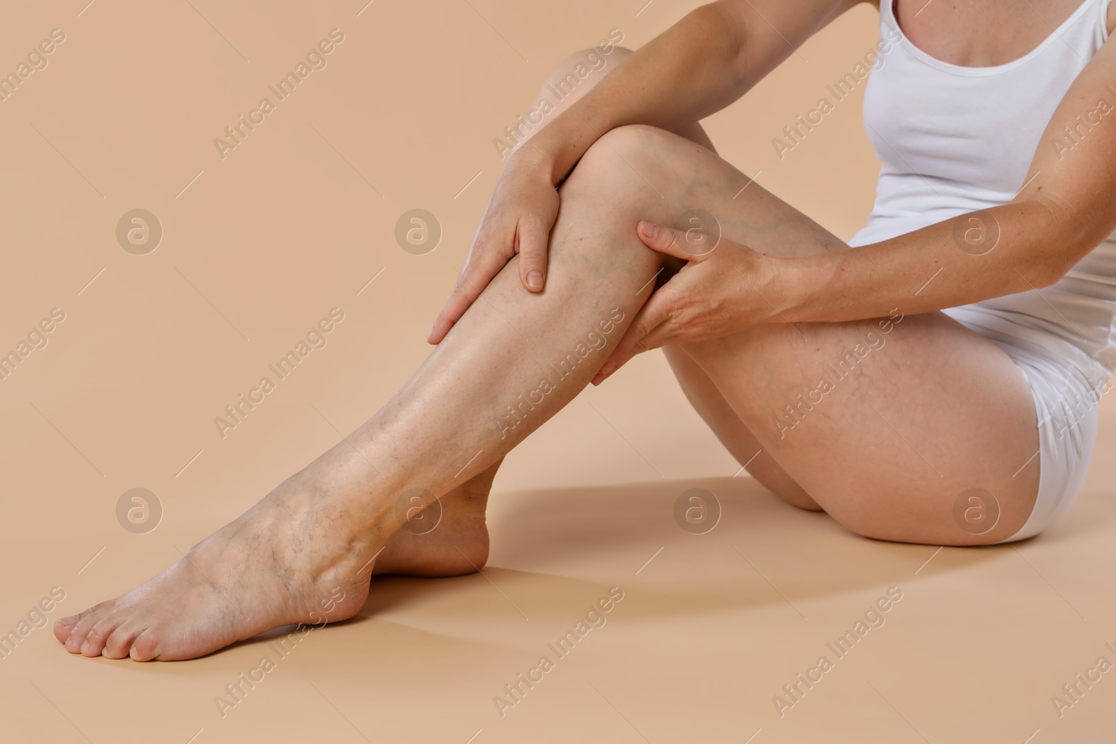 Photo of Woman suffering from varicose veins on beige background, closeup