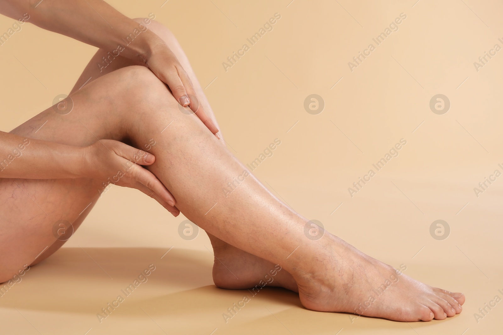 Photo of Woman suffering from varicose veins on beige background, closeup