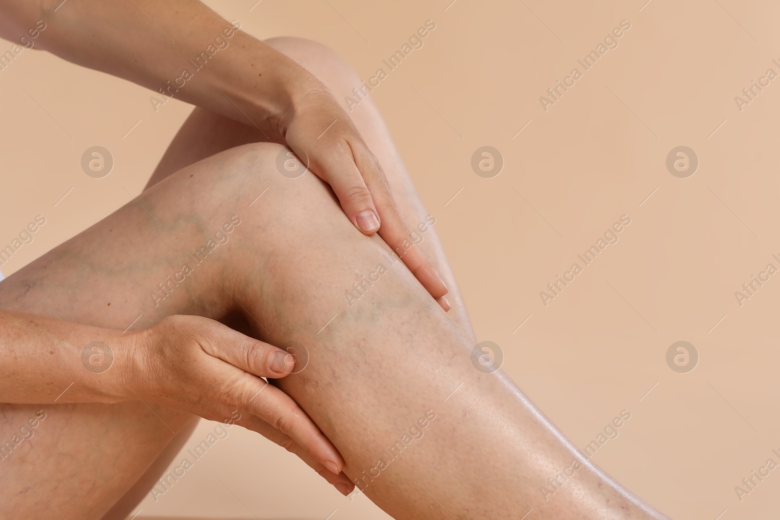 Photo of Woman suffering from varicose veins on beige background, closeup