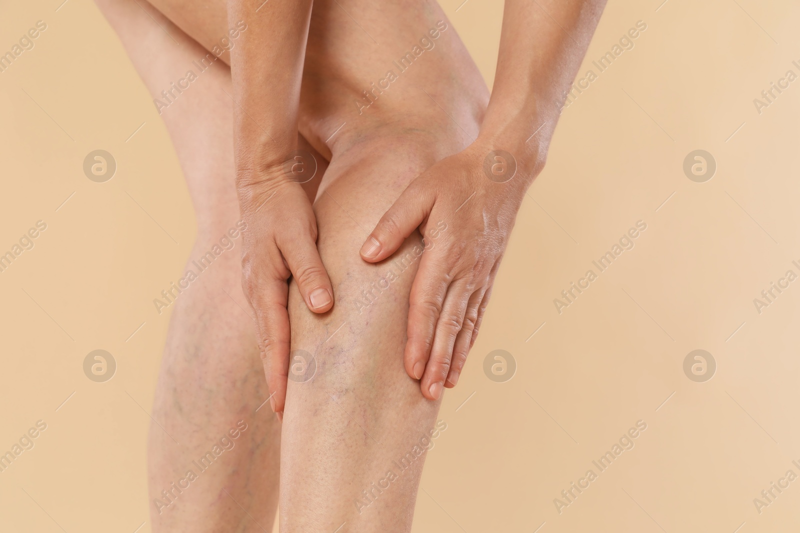 Photo of Woman suffering from varicose veins on beige background, closeup. Space for text