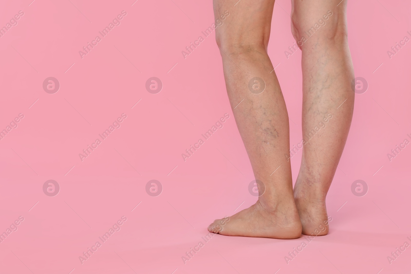 Photo of Woman with varicose veins on pink background, closeup. Space for text