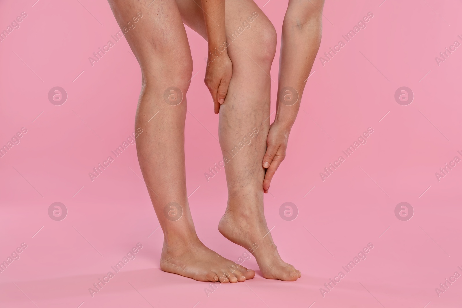 Photo of Woman suffering from varicose veins on pink background, closeup