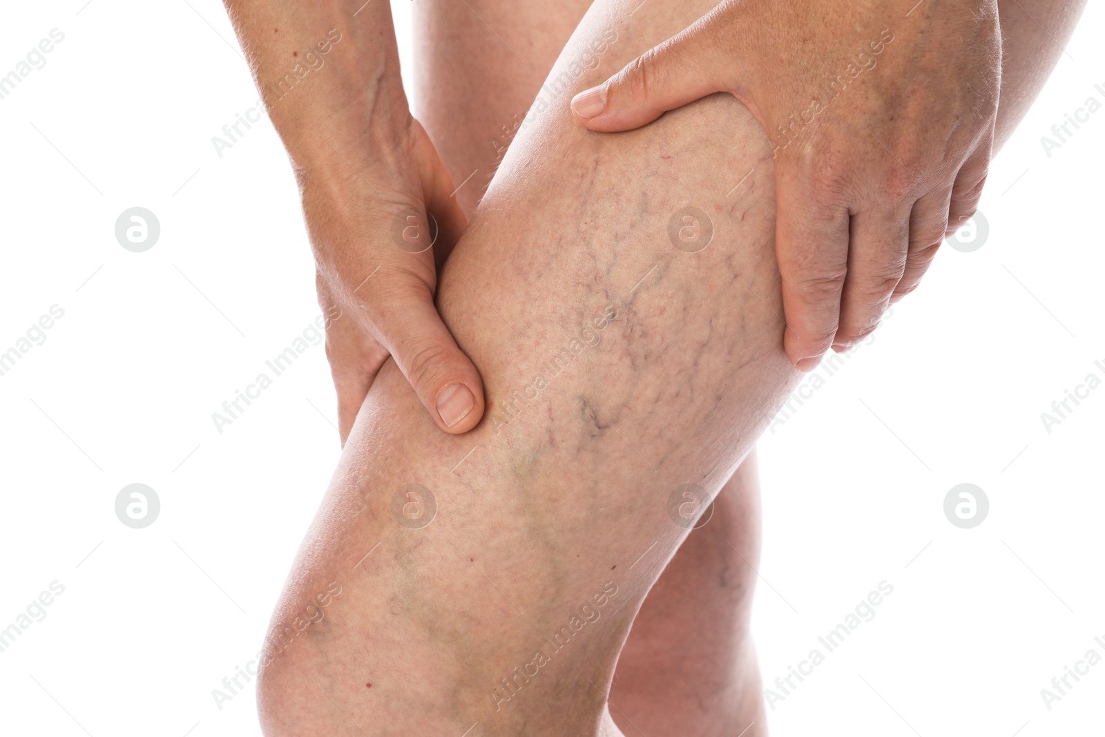 Photo of Woman suffering from varicose veins on white background, closeup