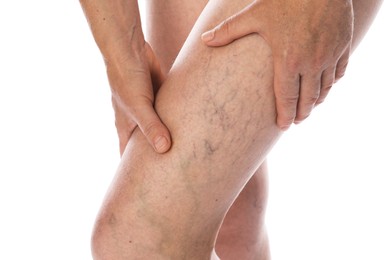 Photo of Woman suffering from varicose veins on white background, closeup