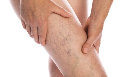 Photo of Woman suffering from varicose veins on white background, closeup