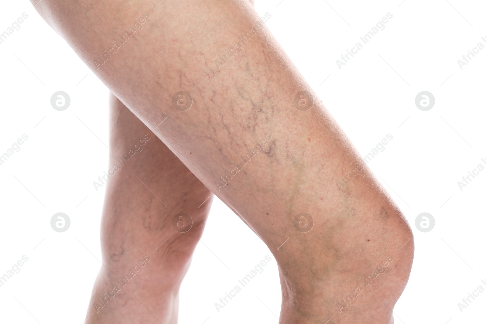 Photo of Woman with varicose veins on white background, closeup