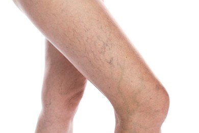 Woman with varicose veins on white background, closeup