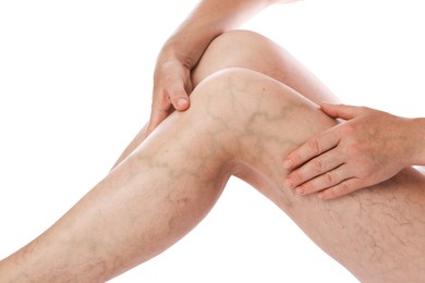 Photo of Woman suffering from varicose veins on white background, closeup