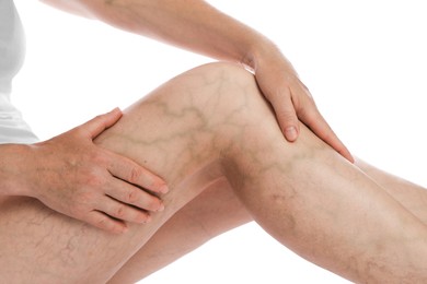 Photo of Woman suffering from varicose veins on white background, closeup