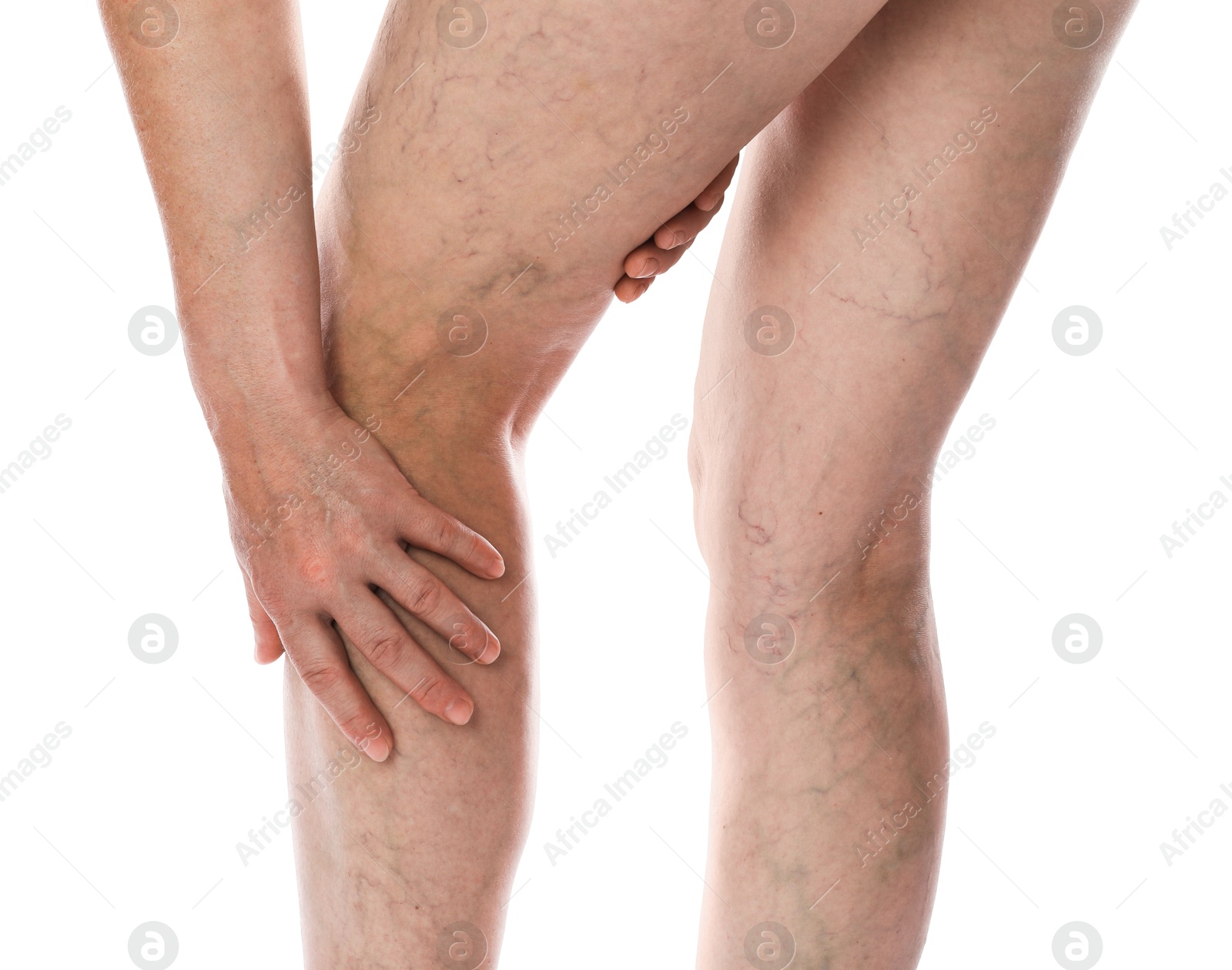 Photo of Woman suffering from varicose veins on white background, closeup