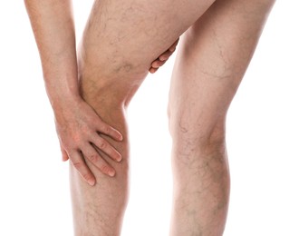 Photo of Woman suffering from varicose veins on white background, closeup