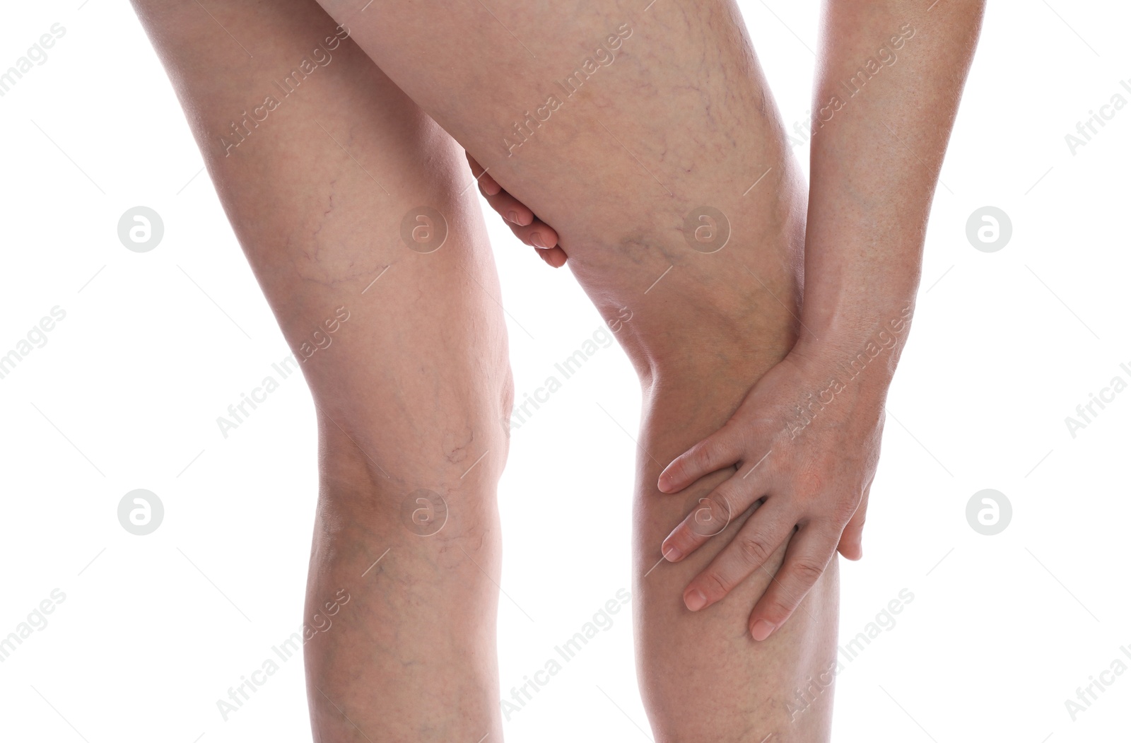 Photo of Woman suffering from varicose veins on white background, closeup