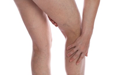 Photo of Woman suffering from varicose veins on white background, closeup