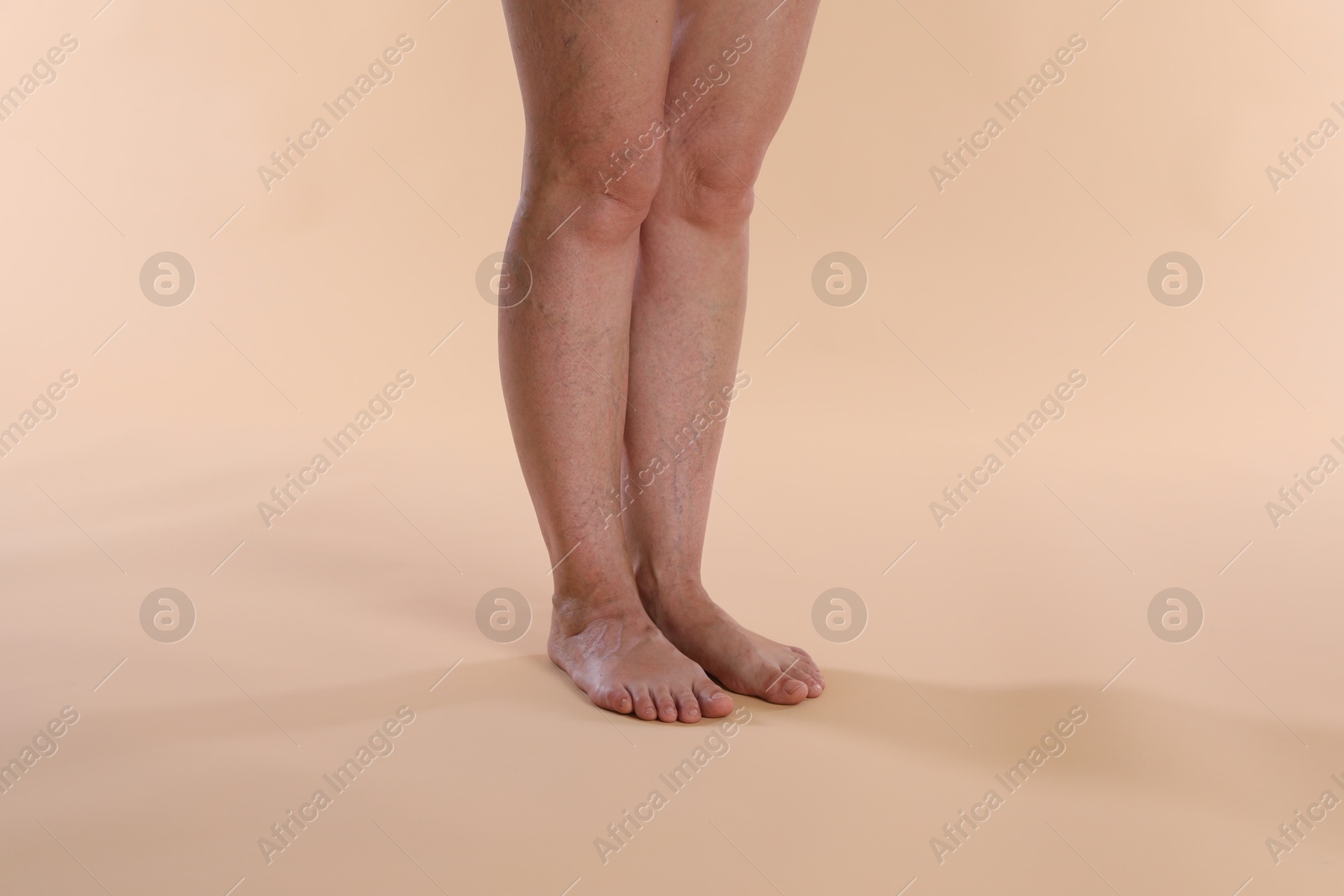 Photo of Woman with varicose veins on beige background, closeup