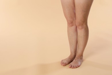 Photo of Woman with varicose veins on beige background, closeup. Space for text