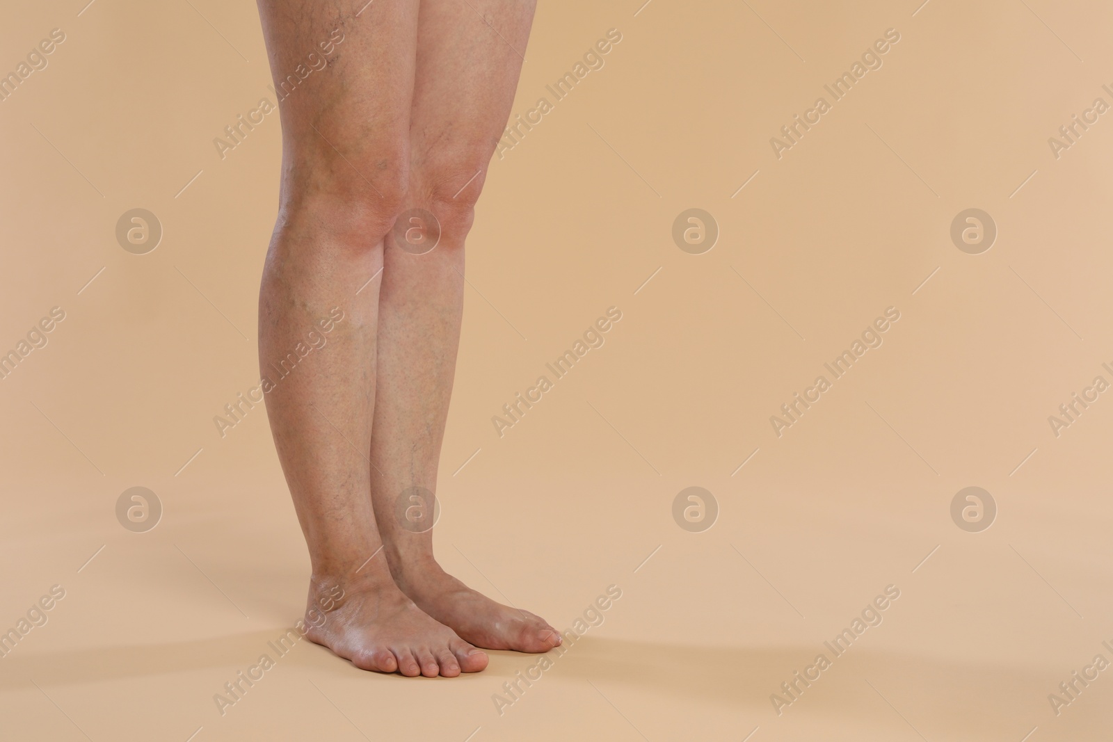 Photo of Woman with varicose veins on beige background, closeup. Space for text