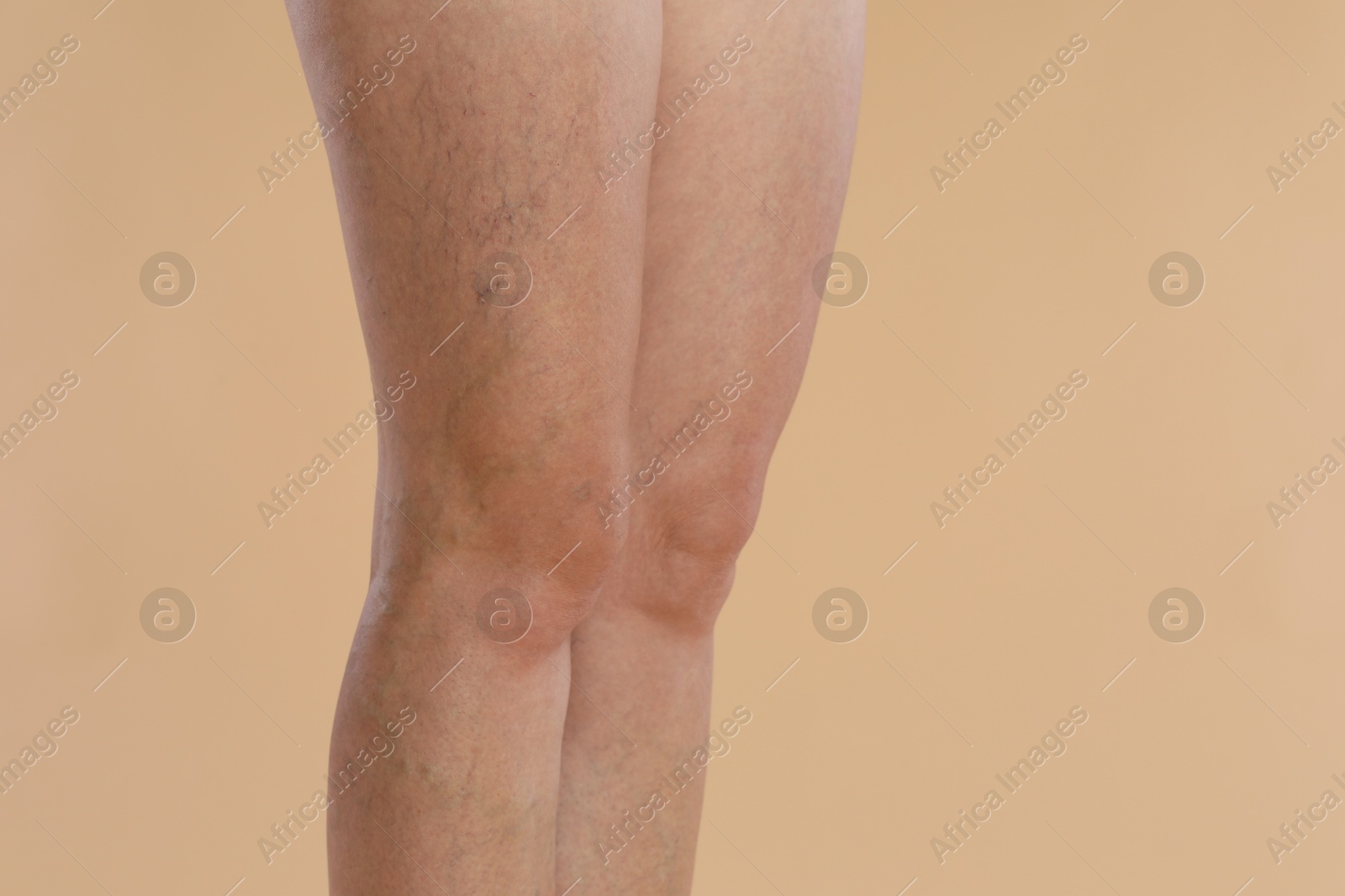 Photo of Woman with varicose veins on beige background, closeup