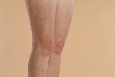 Woman with varicose veins on beige background, closeup