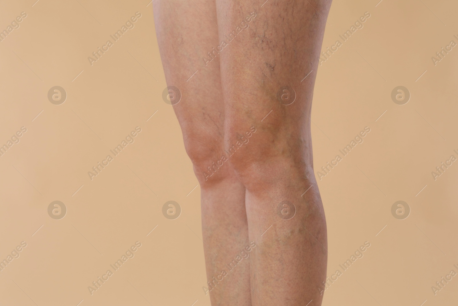 Photo of Woman with varicose veins on beige background, closeup