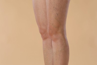 Woman with varicose veins on beige background, closeup