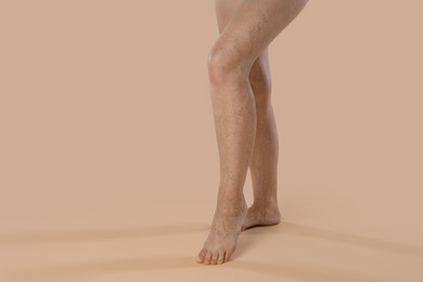 Photo of Woman with varicose veins on beige background, closeup. Space for text