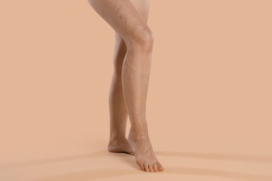 Photo of Woman with varicose veins on beige background, closeup