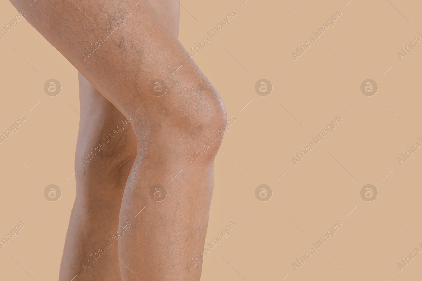 Photo of Woman with varicose veins on beige background, closeup. Space for text