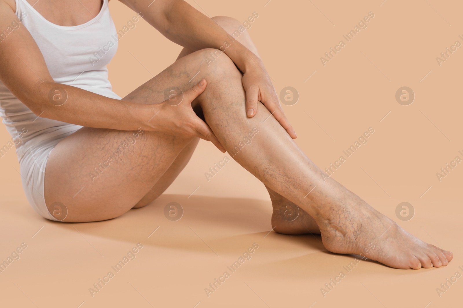 Photo of Woman suffering from varicose veins on beige background, closeup