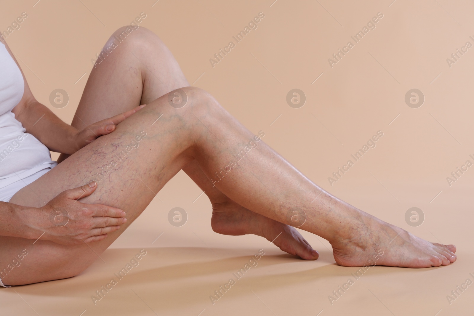 Photo of Woman suffering from varicose veins on beige background, closeup