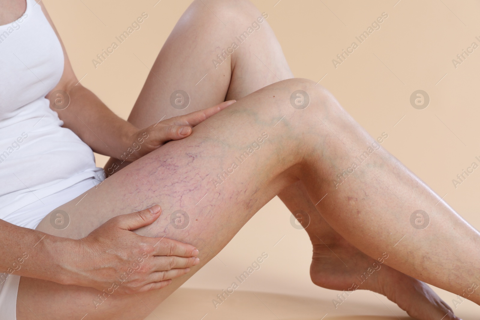 Photo of Woman suffering from varicose veins on beige background, closeup