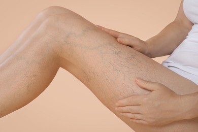 Photo of Woman suffering from varicose veins on beige background, closeup