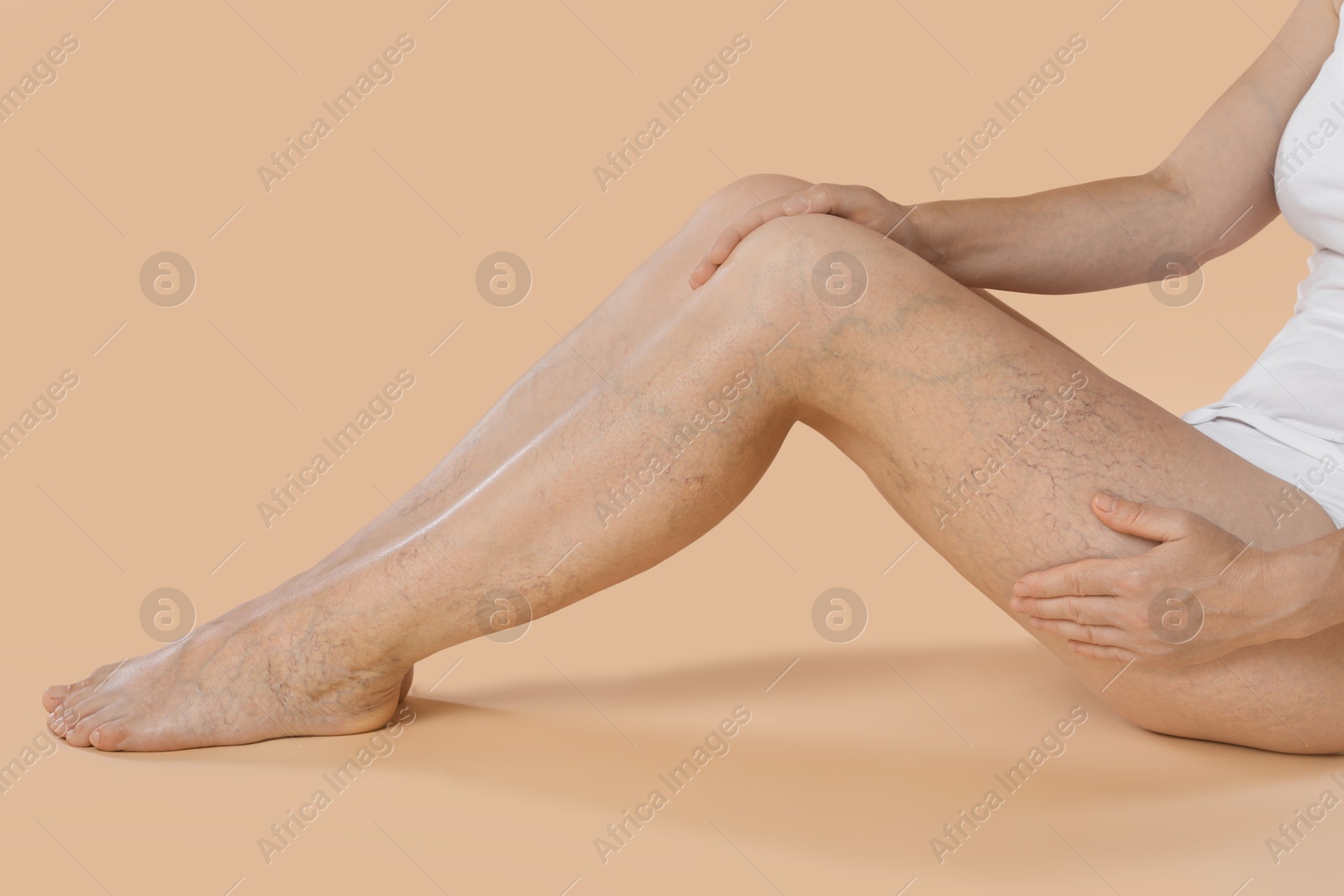 Photo of Woman suffering from varicose veins on beige background, closeup